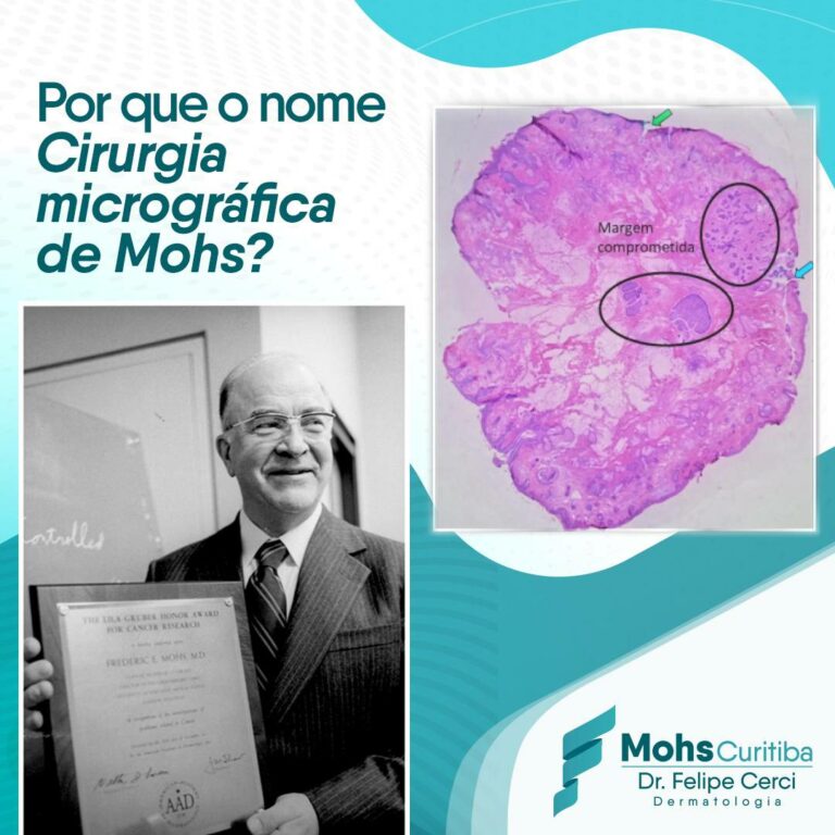 Por que o nome cirurgia micrográfica de Mohs?