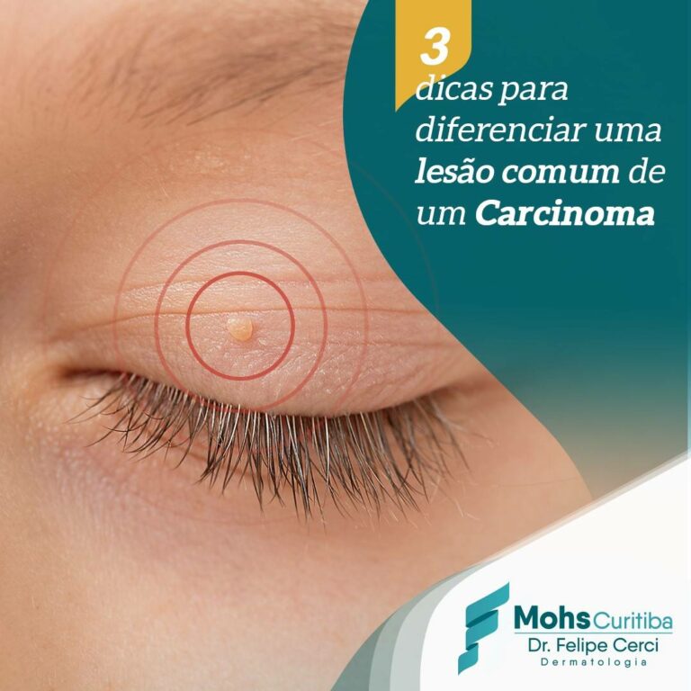 3 dicas para diferenciar uma lesão comum de um carcinoma