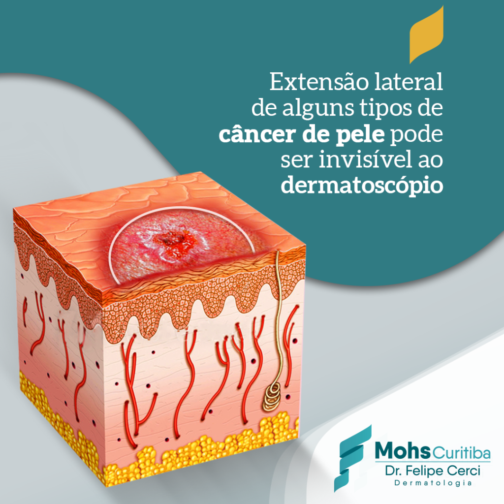 Extensão lateral de alguns tipos de câncer de pele pode ser invisível ao dermatoscópio