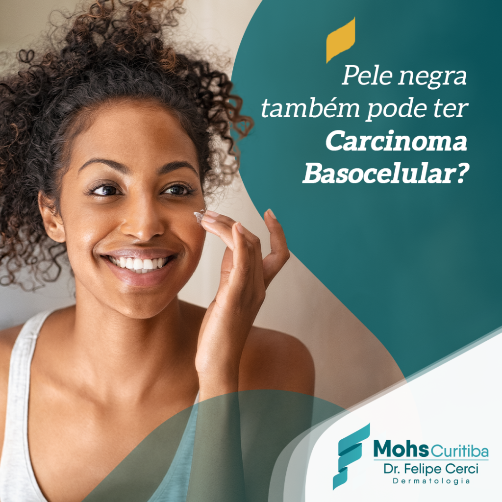 Pele negra também pode ter carcinoma basocelular?