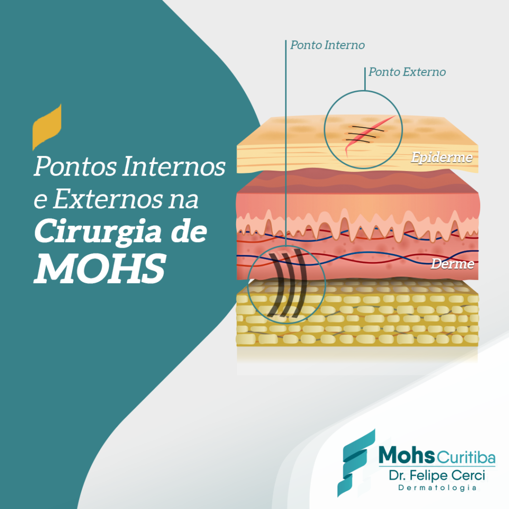 Pontos internos e externos na cirurgia de Mohs