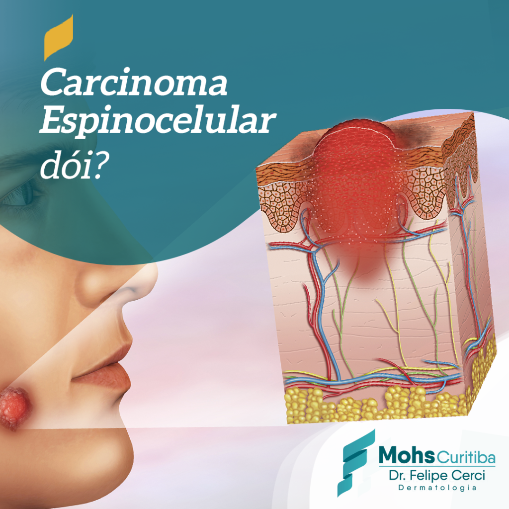 Carcinoma espinocelular dói?