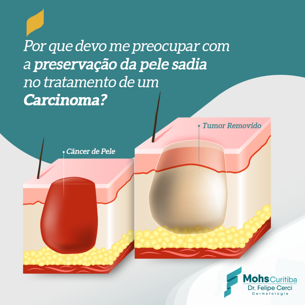 Por que devo me preocupar com a preservação da pele sadia no tratamento de um carcinoma?