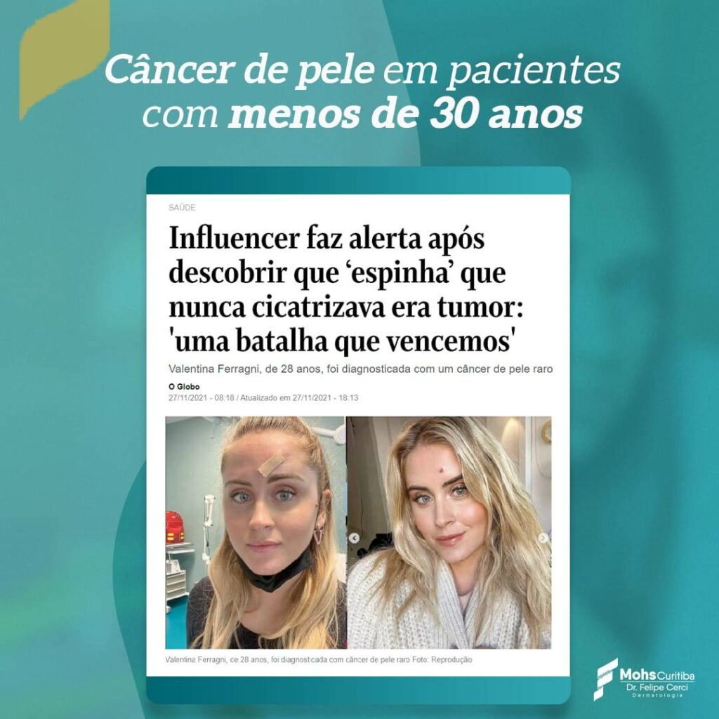 Câncer de pele em pacientes com menos de 30 anos