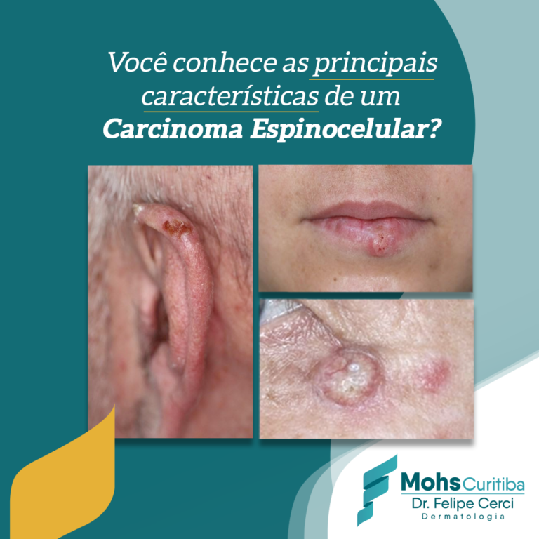 Você conhece as principais características de um carcinoma basocelular?