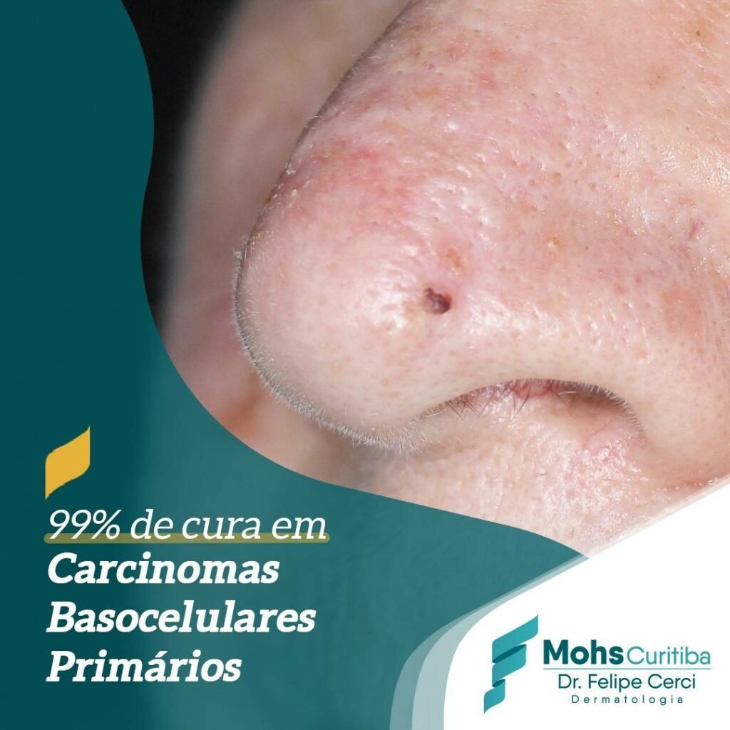 99% de cura em carcinomas basocelulares primários