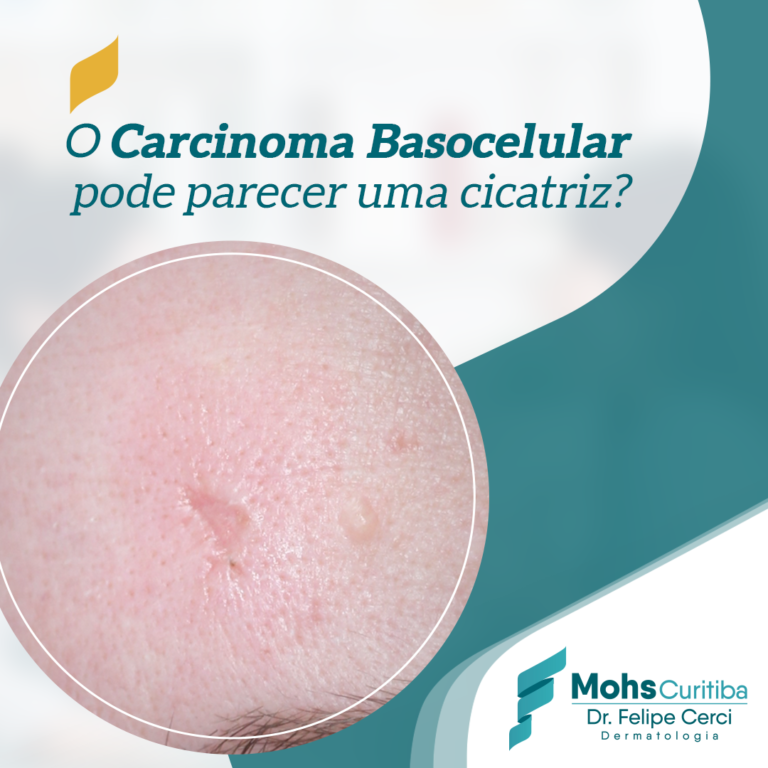 O carcinoma basocelular pode parecer uma cicatriz?