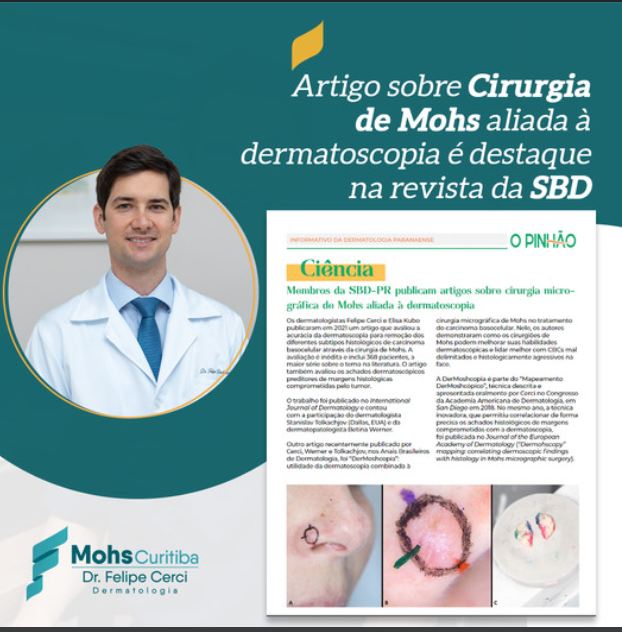 Artigo sobre cirurgia de Mohs aliada à dermatoscopia é destaque na revista da SBD