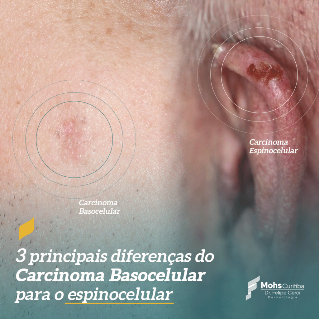 3 principais diferenças do Carcinoma Basocelular para o espinocelular