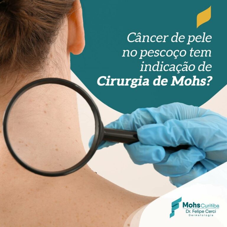 Câncer de pele no pescoço têm indicação de Cirurgia de Mohs?