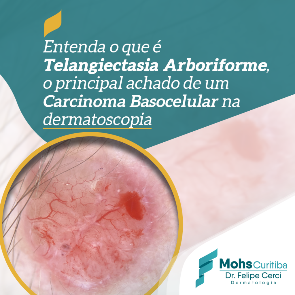 Entenda o que é telangiectasia arboriforme o principal achado de um carcinoma basocelular na dermatoscopia
