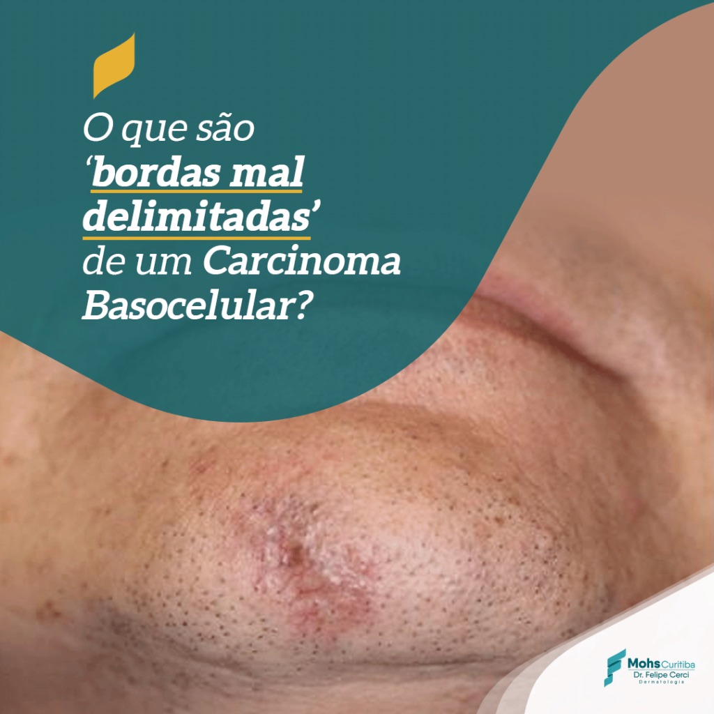 O que são bordas mal delimitadas de um carcinoma basocelular?