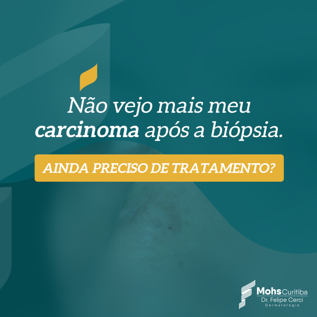 Não vejo mais meu carcinoma após a biópsia. Ainda preciso de tratamento?