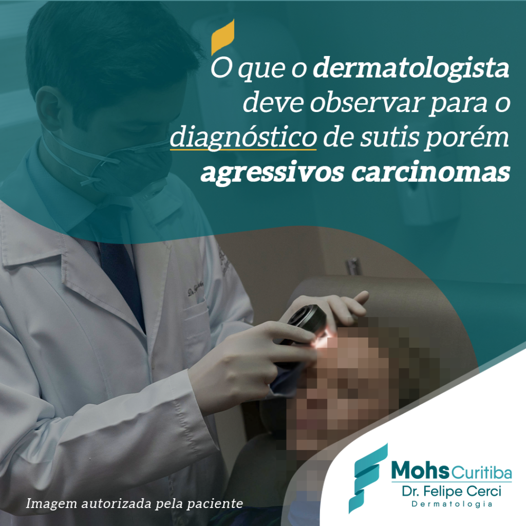O que o dermatologista deve observar para o diagnóstico de sutis porém agressivos carcinomas