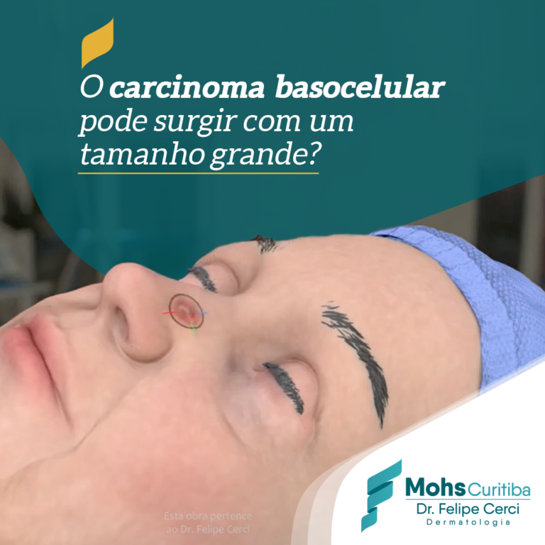 Um carcinoma basocelular pode surgir com um tamanho grande?