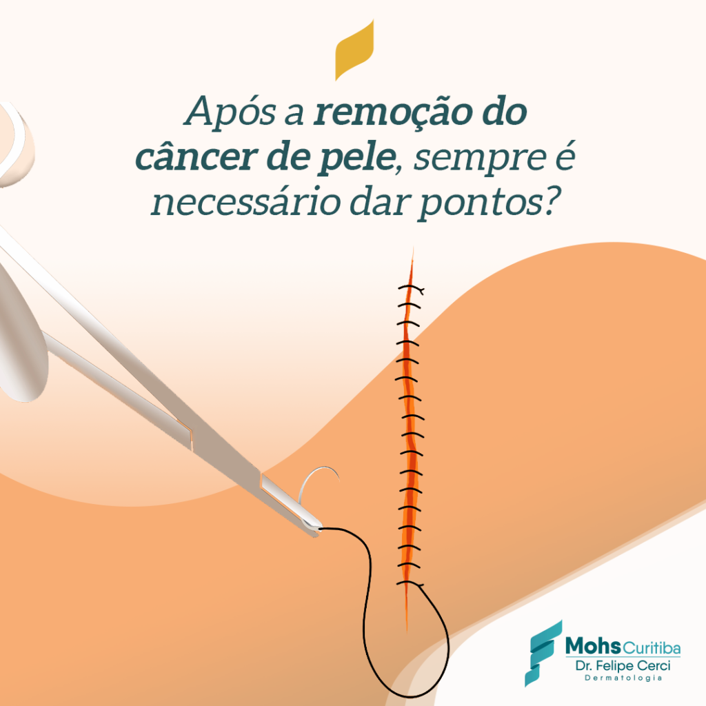Após a remoção do câncer de pele, sempre é necessário dar pontos?