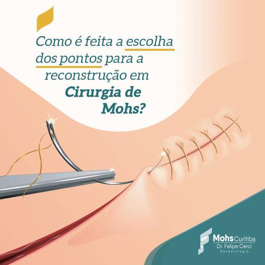 Como é feita a escolha dos pontos para reconstrução em Cirurgia de Mohs?