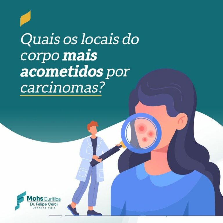 Quais locais do corpo são mais acometidos por carcinomas?