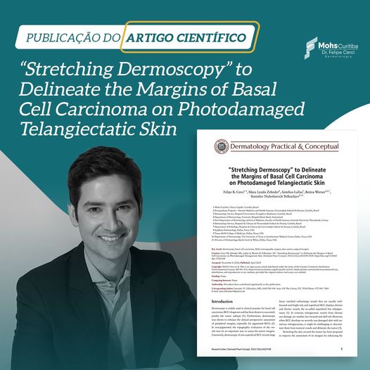 Artigo Científico – Stretching Dermoscopy