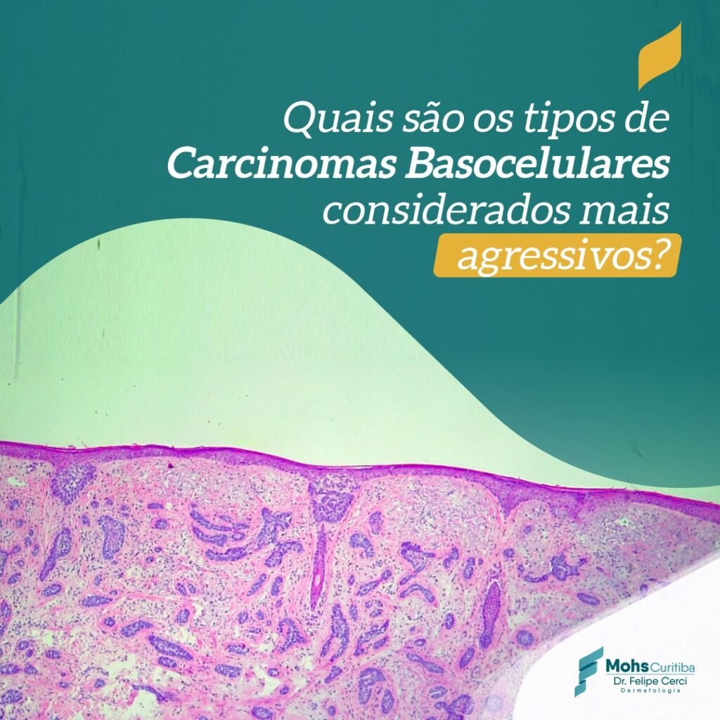 Quais são os tipos de Carcinomas Basocelulares considerados mais agressivos?
