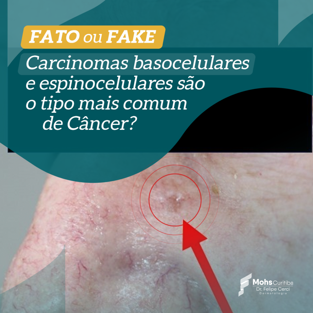 FATO OU FAKE: CARCINOMAS BASOCELULARES E ESPINOCELULARES SÃO O TIPO MAIS COMUM DE CÂNCER?