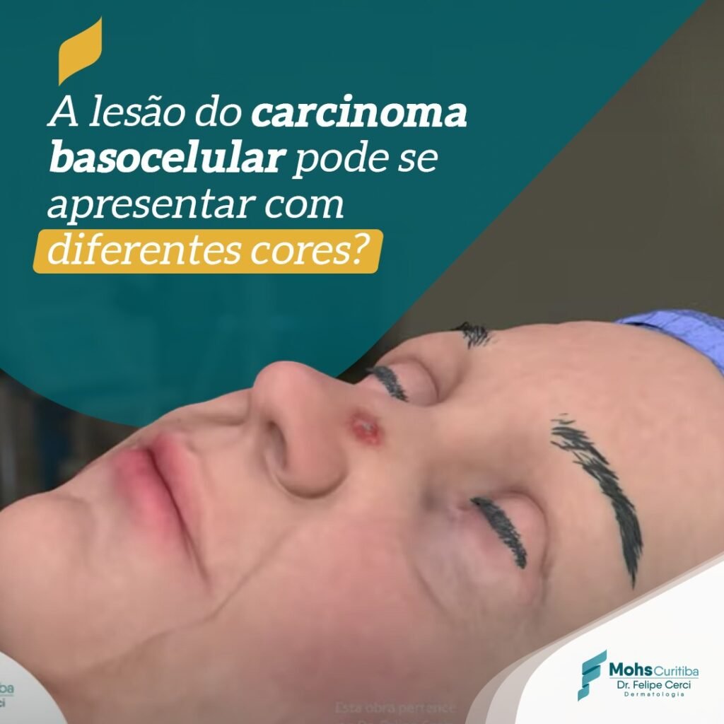 A LESÃO DO CARCINOMA BASOCELULAR PODE SE APRESENTAR COM DIFERENTES CORES?