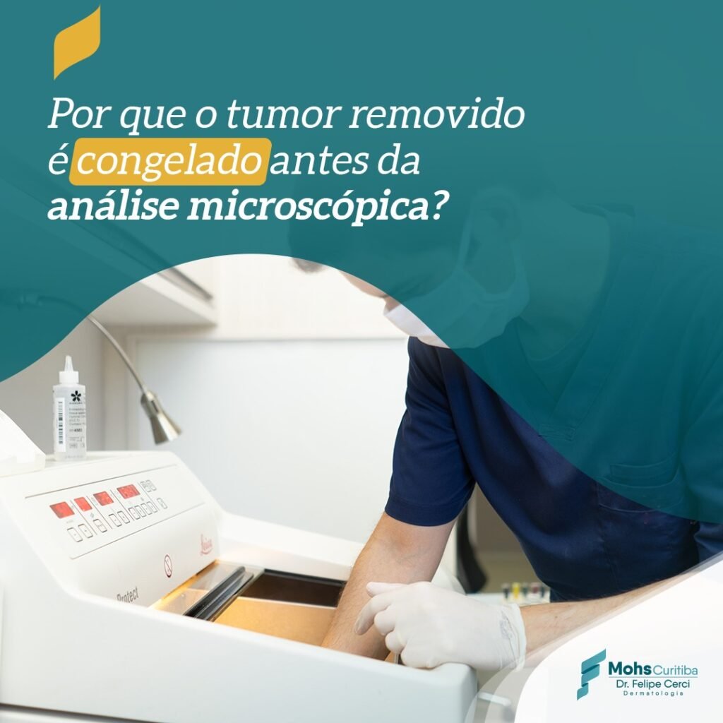Por que o tumor removido é congelado antes da análise microscópica?