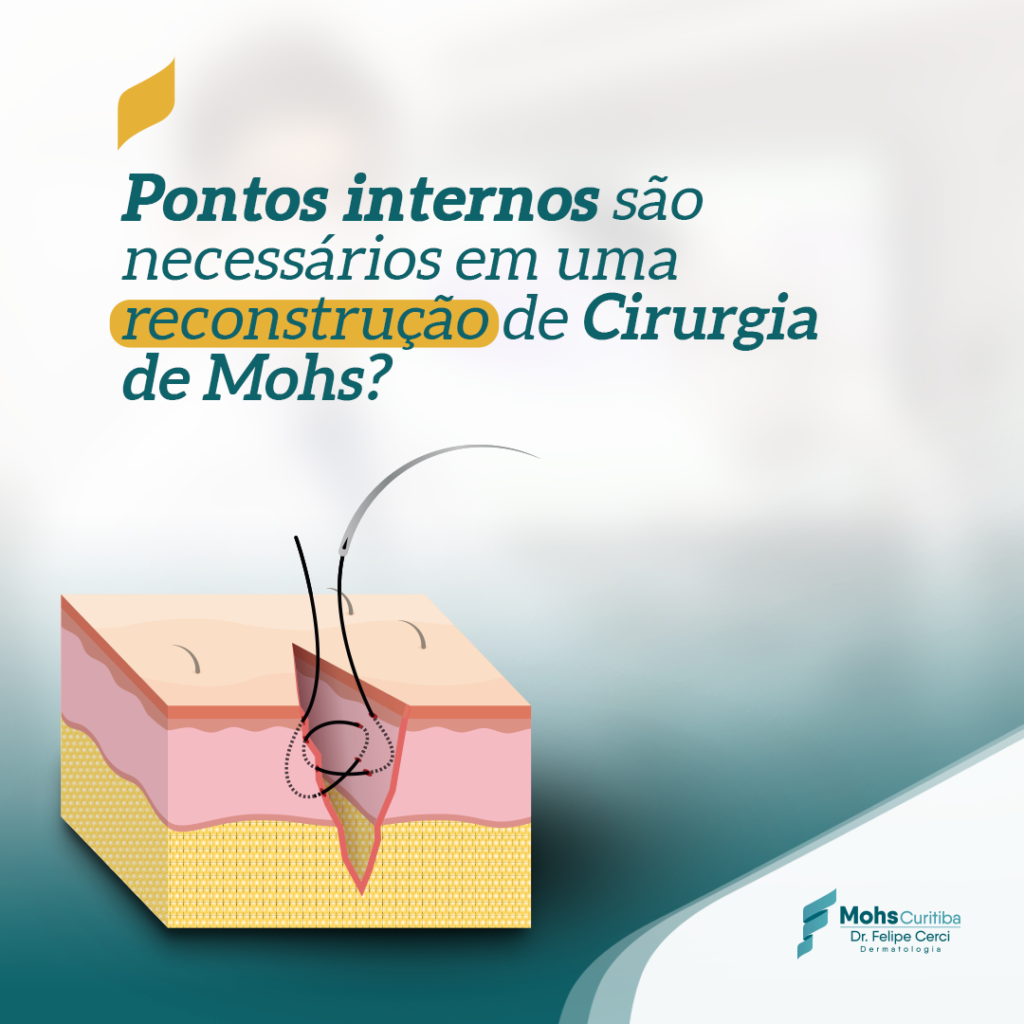 PONTOS INTERNOS SÃO NECESSÁRIOS EM UMA RECONSTRUÇÃO DE CIRURGIA DE MOHS?