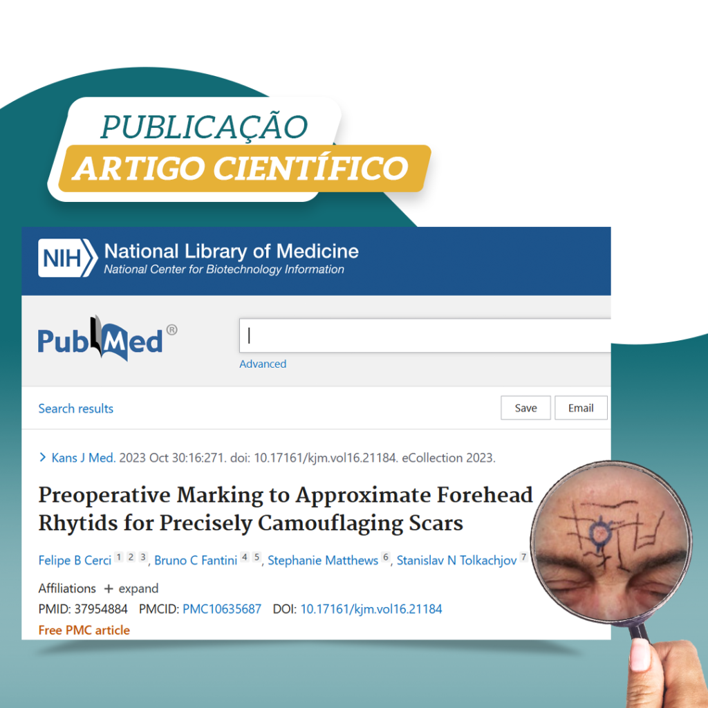 PUBLICAÇÃO DE ARTIGO CIENTÍFICO “Preoperative Marking to Approximate Forehead Rhytids for Precisely Camouflaging Scars”