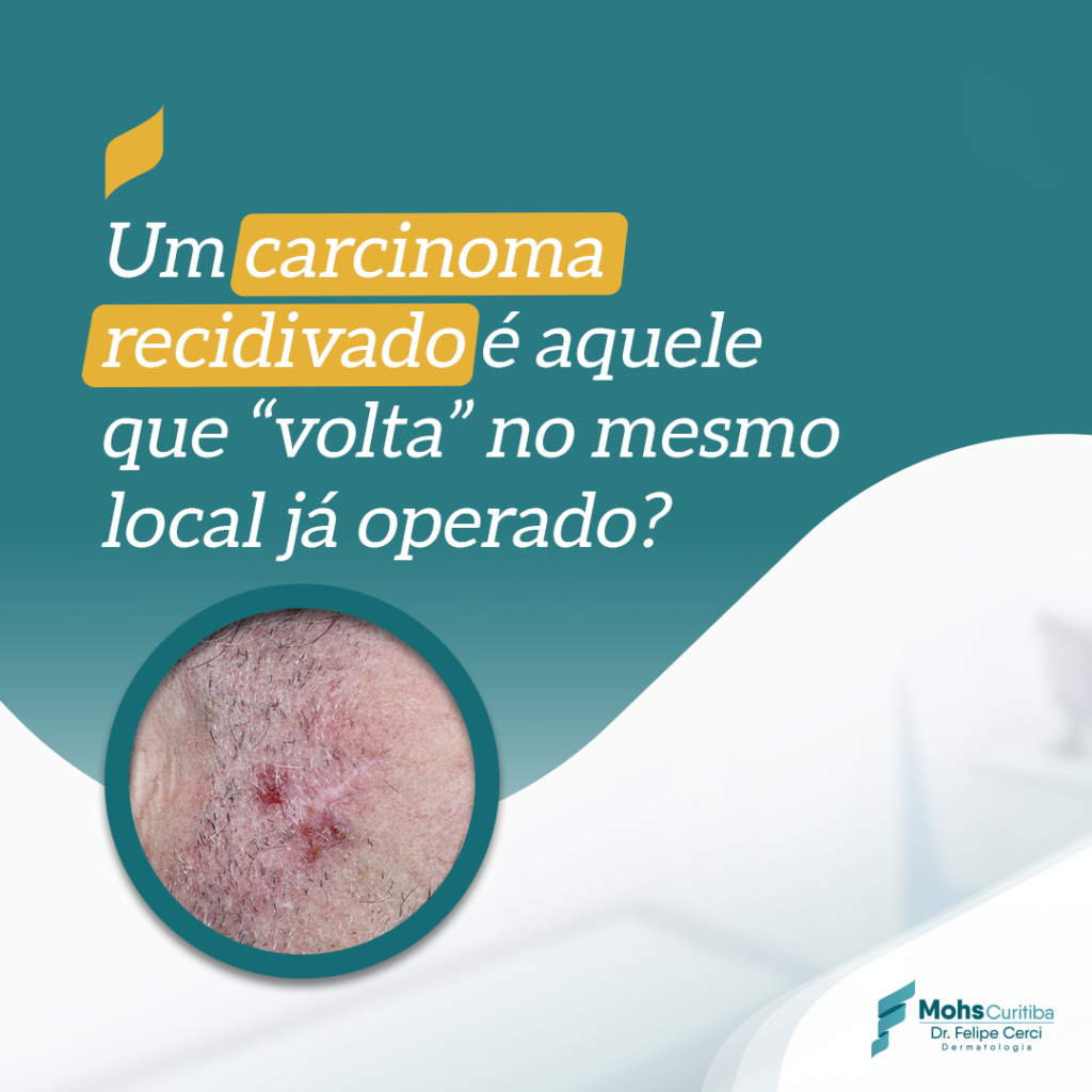 Um carcinoma recidivado é aquele que “volta” no mesmo local já operado?