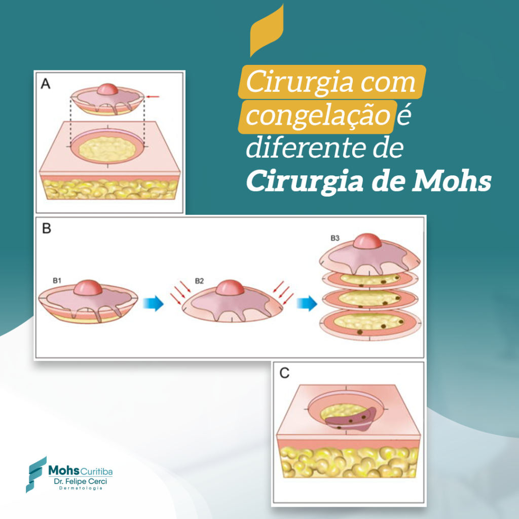 CIRURGIA COM CONGELAÇÃO É DIFERENTE DE CIRURGIA DE MOHS!!
