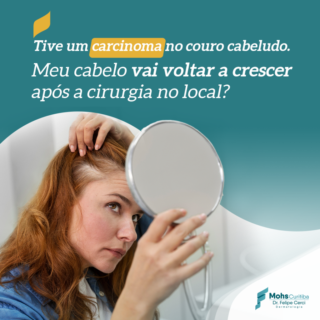 TIVE UM CARCINOMA NO COURO CABELUDO. MEU CABELO VAI VOLTAR A CRESCER APÓS A CIRURGIA NO LOCAL?