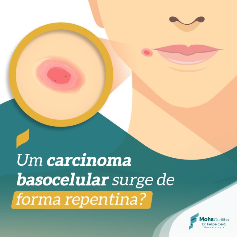 Um carcinoma basocelular surge de forma repentina?