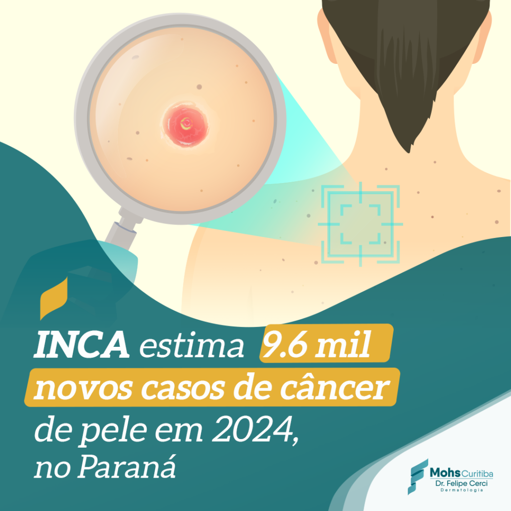 INCA ESTIMA 9.6 MIL NOVOS CASOS DE C NCER DE PELE EM 2024, NO PARANÁ
