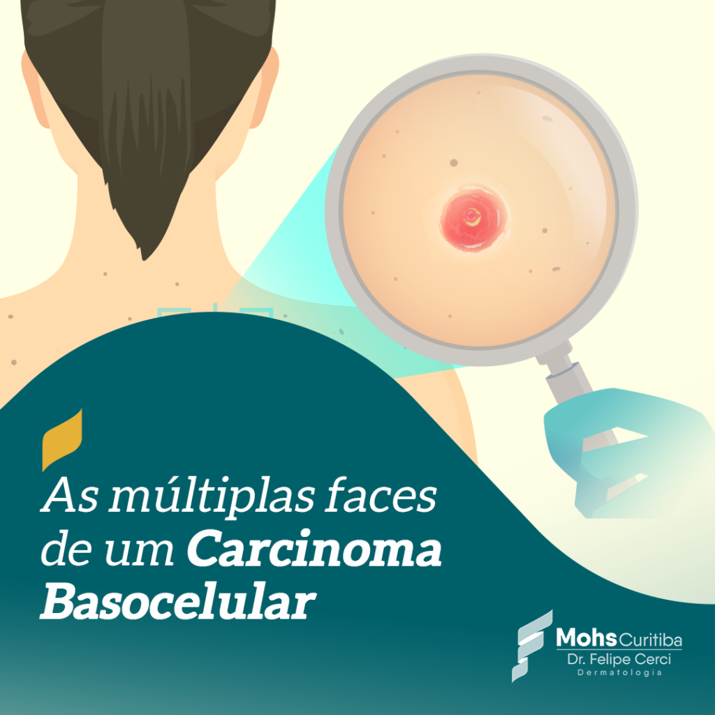 AS MÚLTIPLAS FACES DE UM CARCINOMA BASOCELULAR