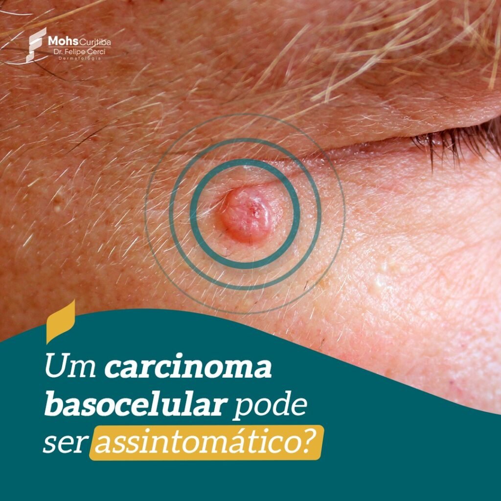 Um carcinoma basocelular pode ser assintomático?
