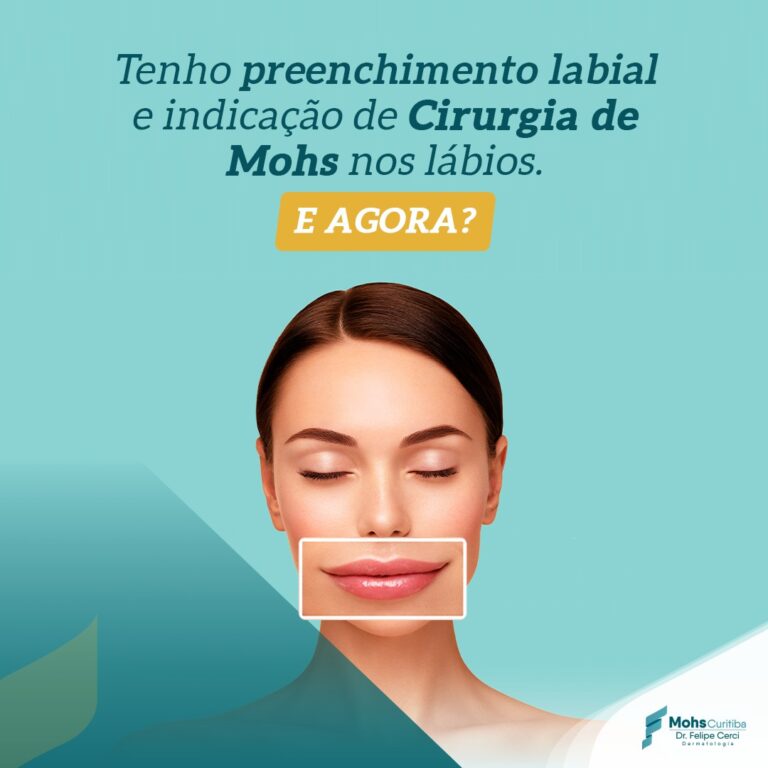 Tenho preenchimento labial e indicação de Cirurgia de Mohs nos lábios. E agora?