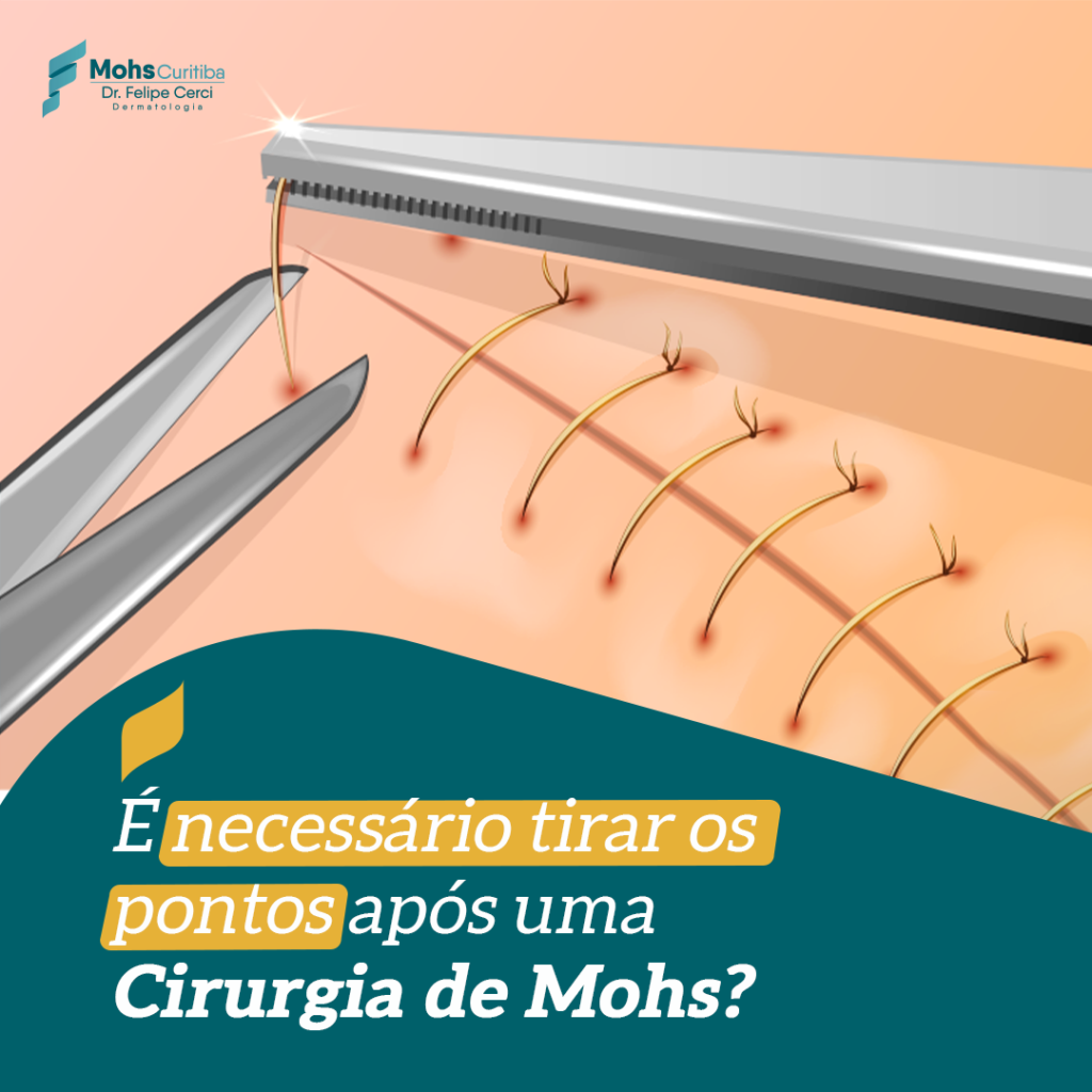 É NECESSÁRIO TIRAR OS PONTOS APÓS UMA CIRURGIA DE MOHS?