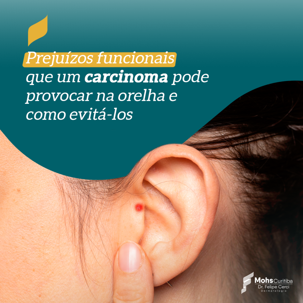 PREJUÍZOS FUNCIONAIS QUE UM CARCINOMA PODE PROVOCAR NA ORELHA E COMO EVITÁ-LOS