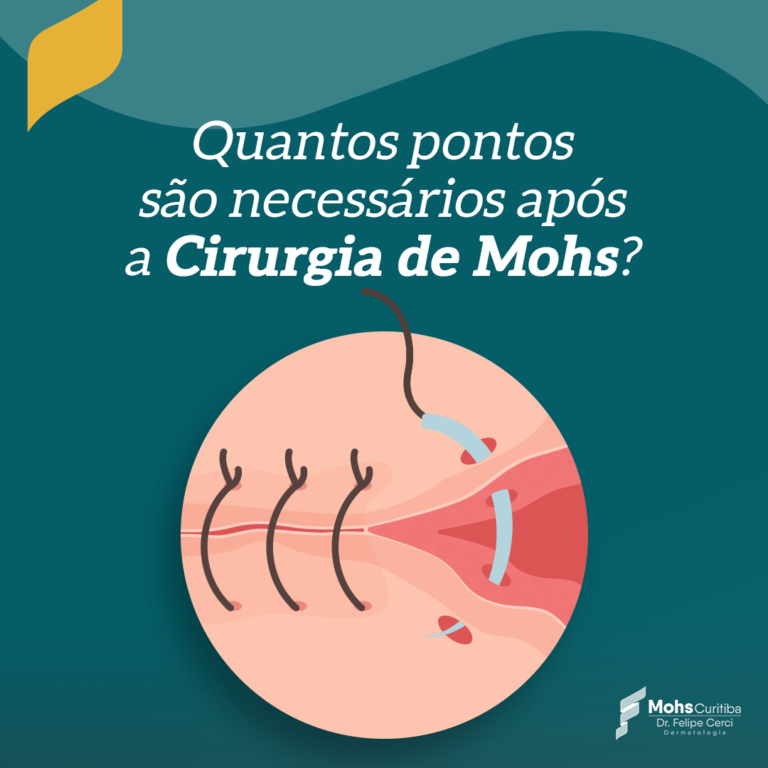 QUANTOS PONTOS SÃO NECESSÁRIOS APÓS A CIRURGIA DE MOHS?