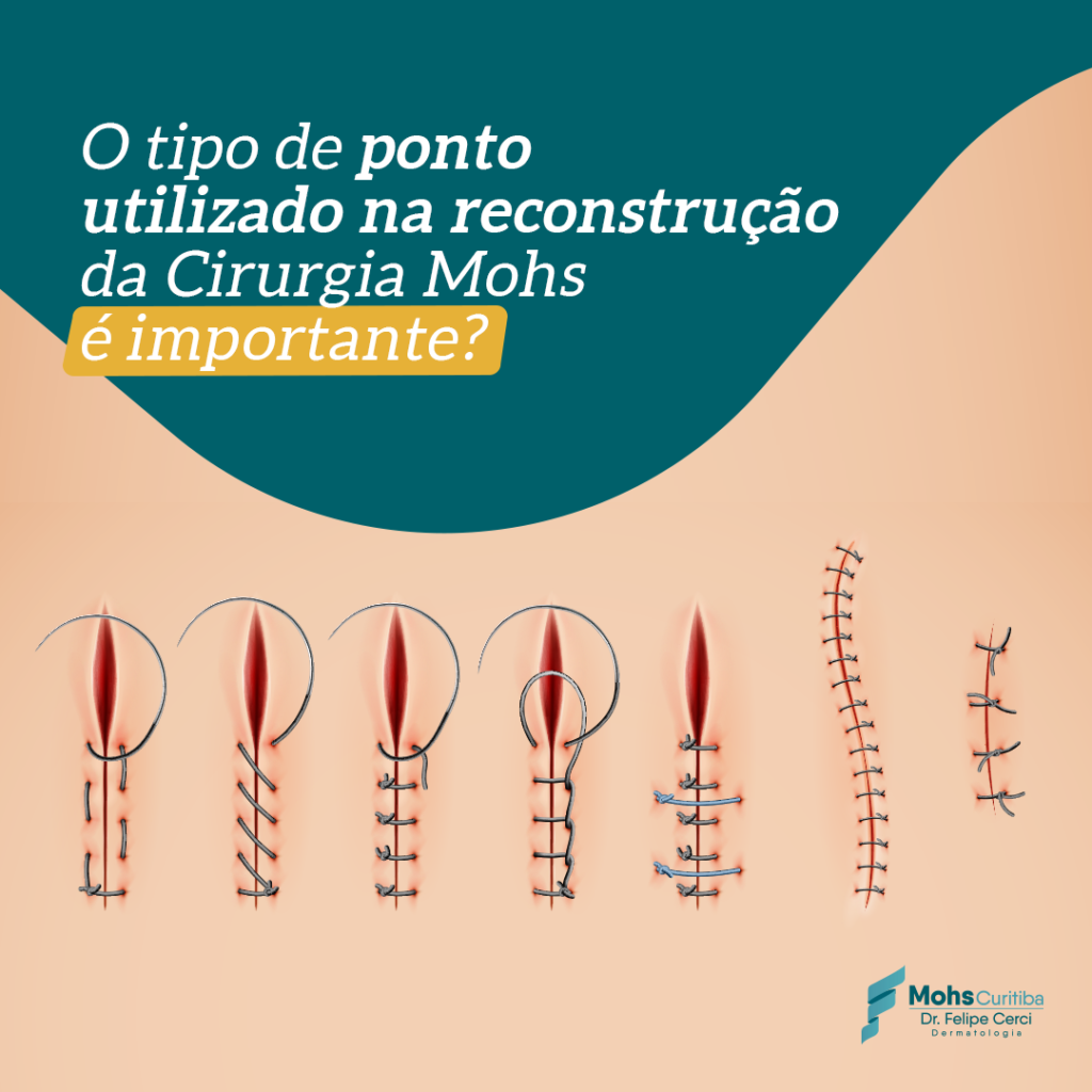 O TIPO DE PONTO UTILIZADO NA RECONSTRUÇÃO DA CIRURGIA MOHS É IMPORTANTE?