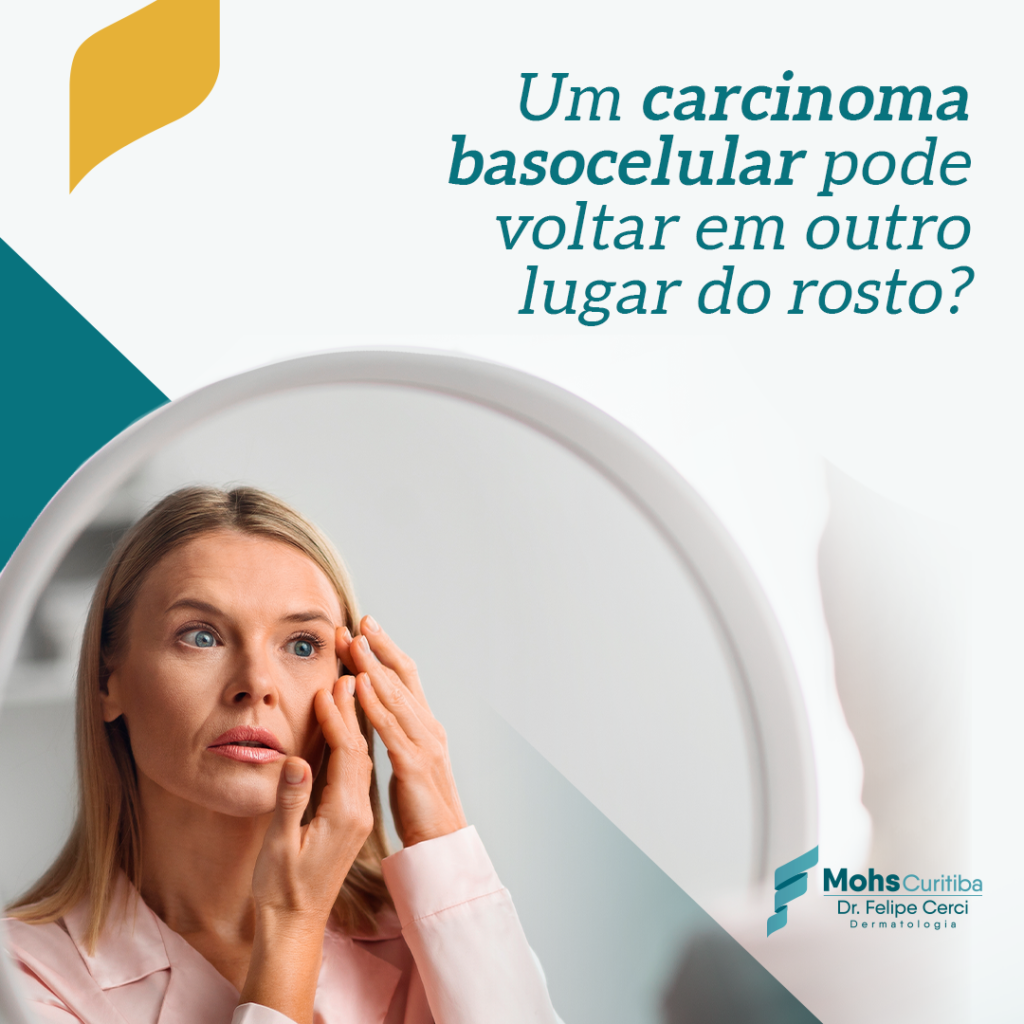 UM CARCINOMA BASOCELULAR PODE VOLTAR EM OUTRO LUGAR DO ROSTO?
