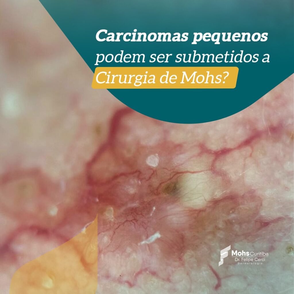 Carcinomas pequenos podem ser submetidos a Cirurgia de Mohs?