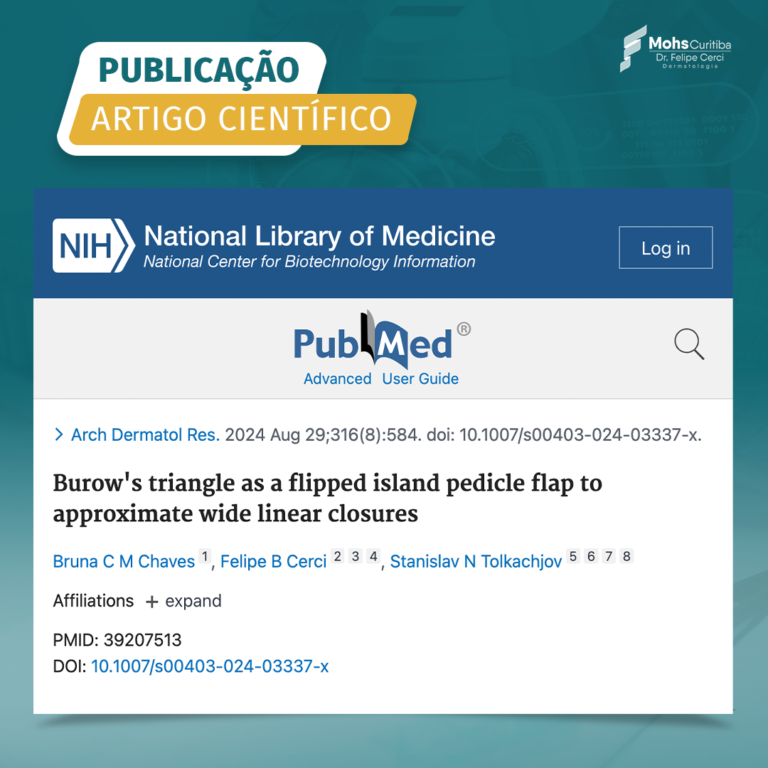 PUBLICAÇÃO DO ARTIGO: “Burow’s triangle as a flipped island pedicle flap to approximate wide linear closures”