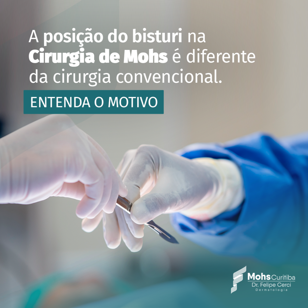 A POSIÇÃO DO BISTURI NA CIRURGIA DE MOHS É DIFERENTE DA CIRURGIA CONVENCIONAL. ENTENDA O MOTIVO