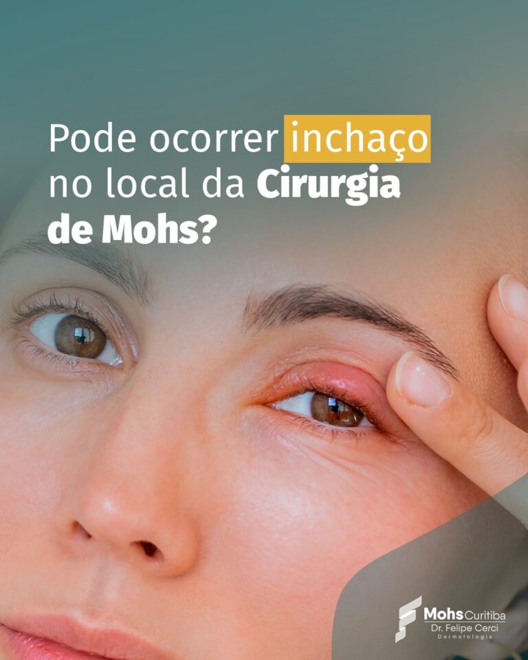 Pode ocorrer inchaço no local da Cirurgia de Mohs?