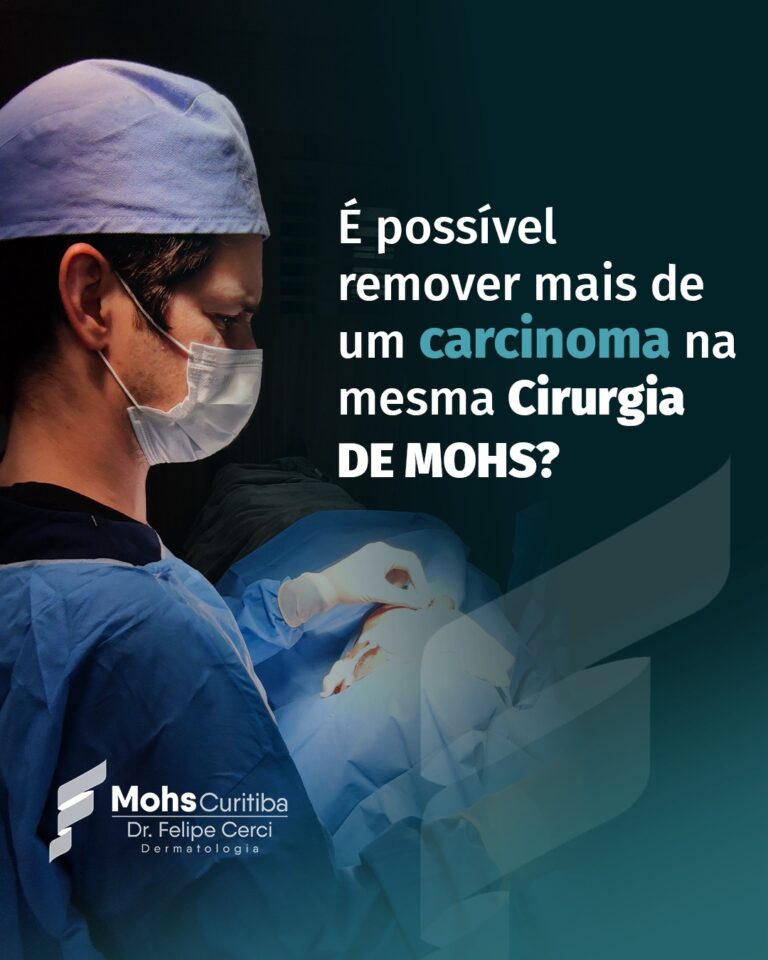 É possível remover mais de um carcinoma na Cirurgia de Mohs?