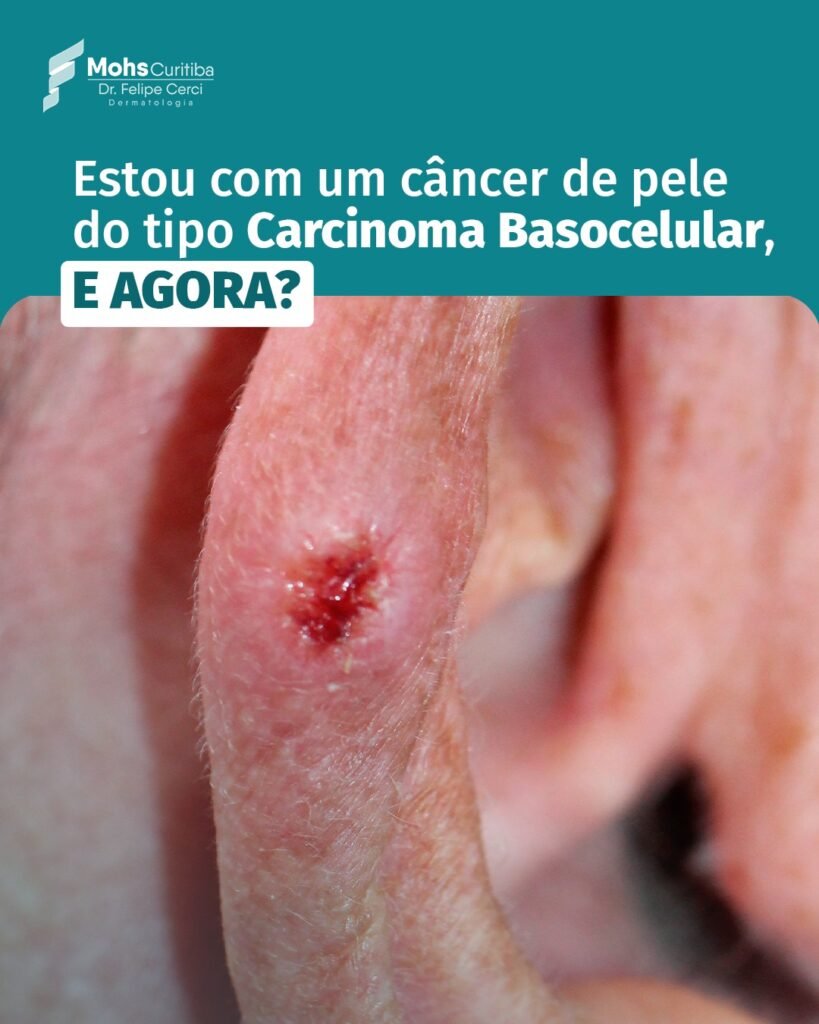 Estou com um câncer de pele do tipo Carcinoma Basocelular, e agora?