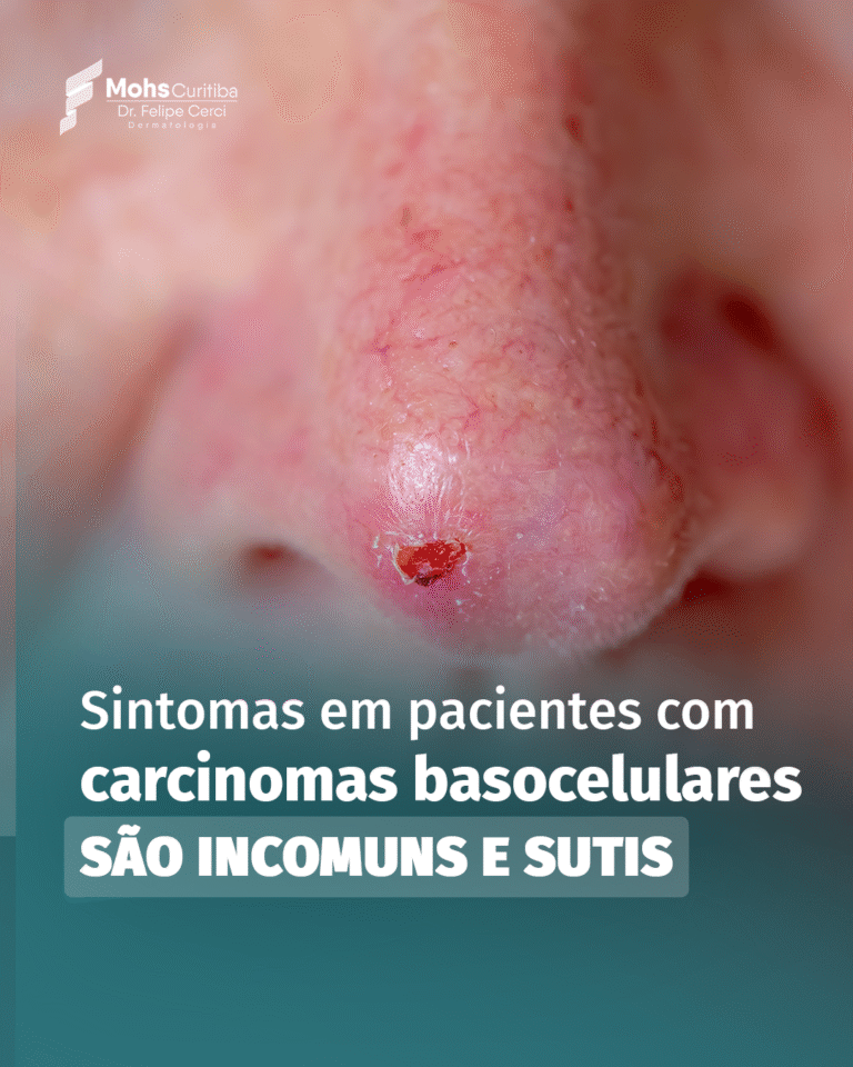SINTOMAS EM PACIENTES COM CARCINOMAS BASOCELULARES SÃO INCOMUNS E SUTIS