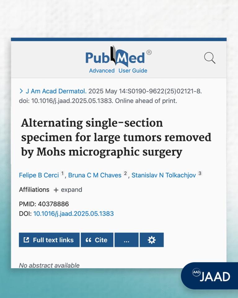 Artigo publicado na principal revista de dermatologia do mundo “Alternating single section specimen for large tumors removed by Mohs micrographic surgery